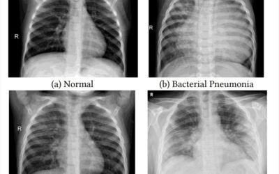Transfer learning exploits chest-Xray to diagnose COVID-19 pneumonia